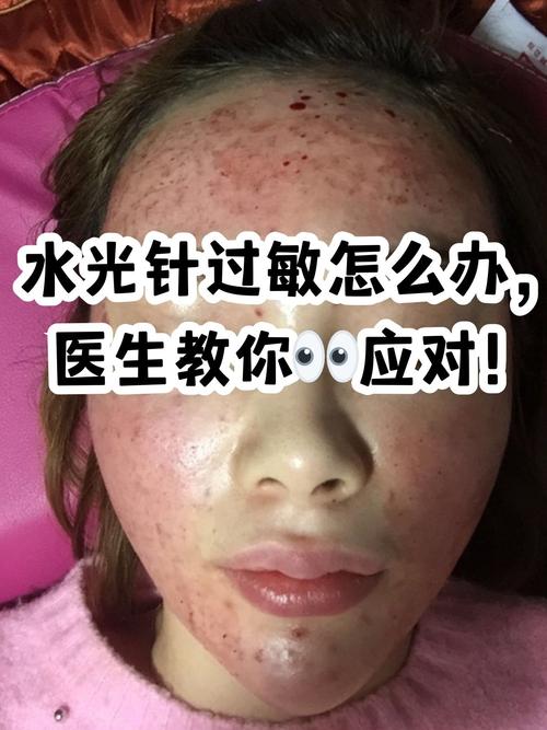 皮肤过敏能打水光针吗