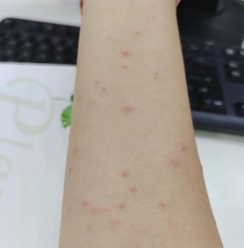 艾灸后皮肤痒出红疙瘩是过敏还是排反应?