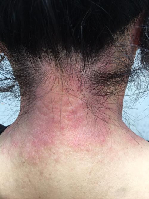 艾灸后皮肤痒出红疙瘩是过敏还是排反应?