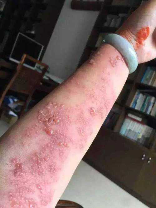 艾灸后皮肤痒出红疙瘩是过敏还是排反应?