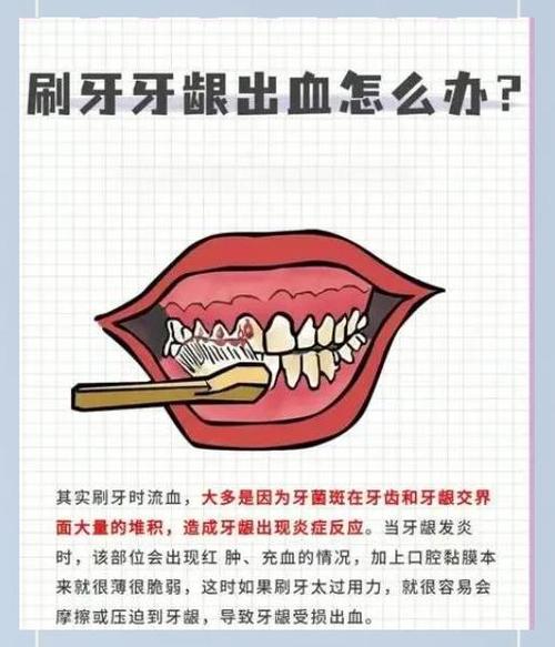 早上口腔出血是啥原因?