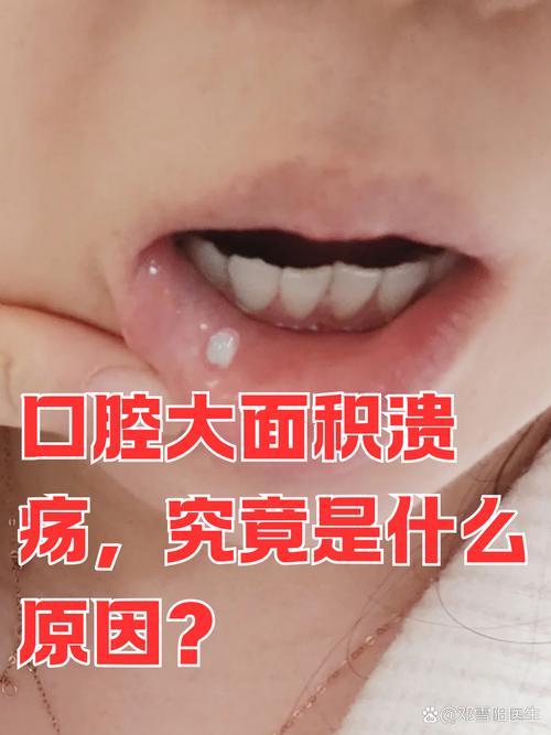 口腔溃疡是怎么造成的