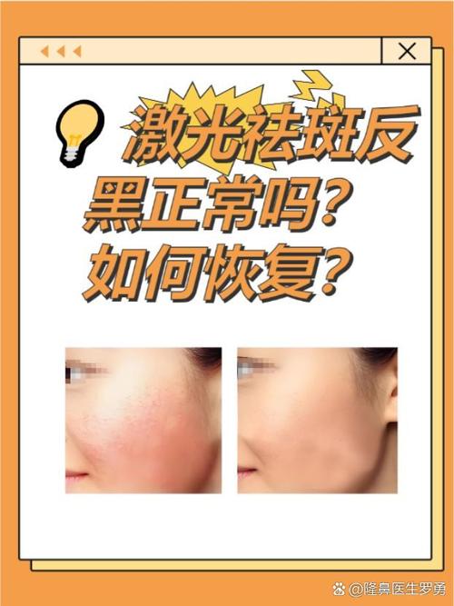 激光祛斑会伤皮肤吗?