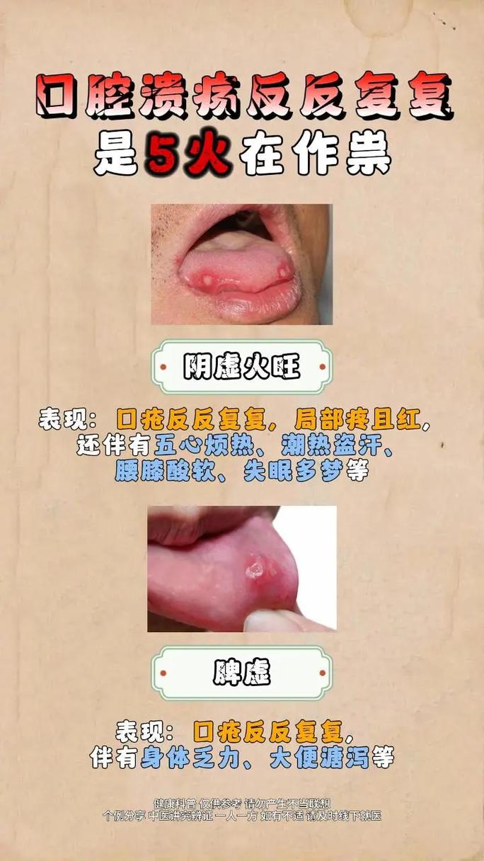 口腔溃疡发红是炎症加重了吗?