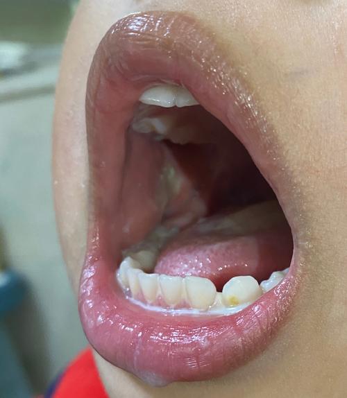 小孩口腔溃疡发烧怎么办?