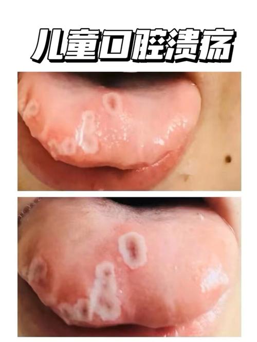 小孩口腔溃疡发烧怎么办?
