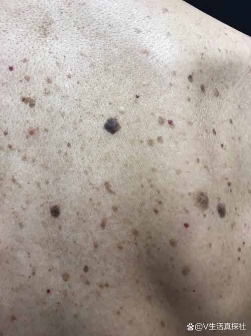 皮肤脂溢性角化病图片长这样正常吗?