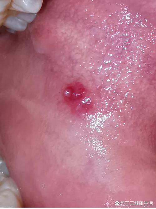 口腔长了个小肉疙瘩图