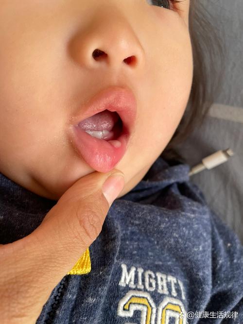 口腔长了个小肉疙瘩图