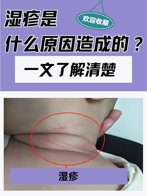 皮肤湿疹是怎样引起的