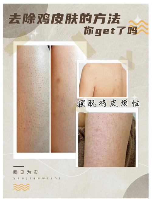 大腿鸡皮肤怎么消除?