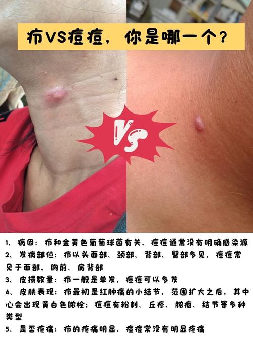 口腔溃疡伴颈部硬结是何原因?