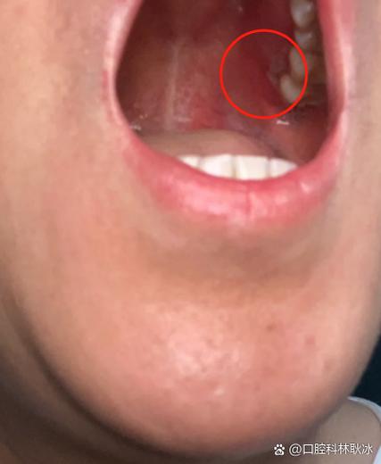 口腔溃疡伴颈部硬结是何原因?