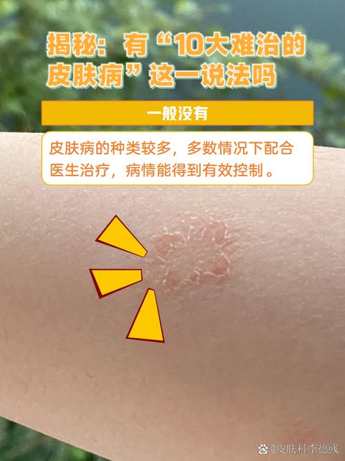 什么病需做皮肤活检?