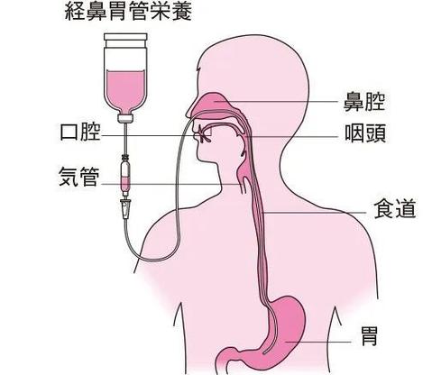 胃管为什么会盘在口腔