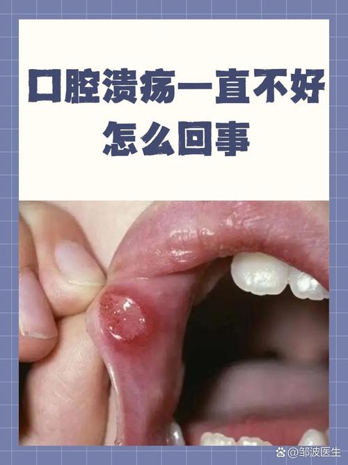 胃病会引起口腔溃疡吗