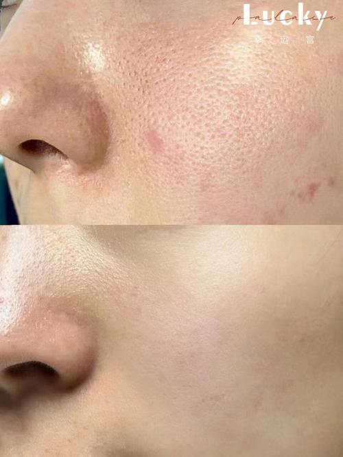 干皮也会毛孔粗大?原因是什么?