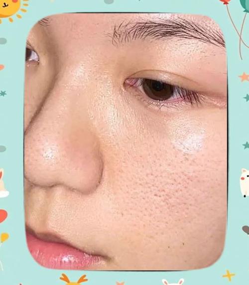 干皮也会毛孔粗大?原因是什么?