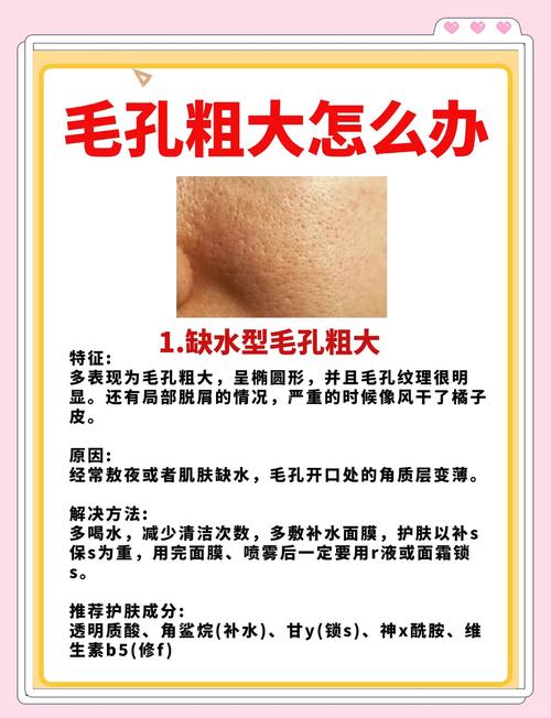 干皮也会毛孔粗大?原因是什么?