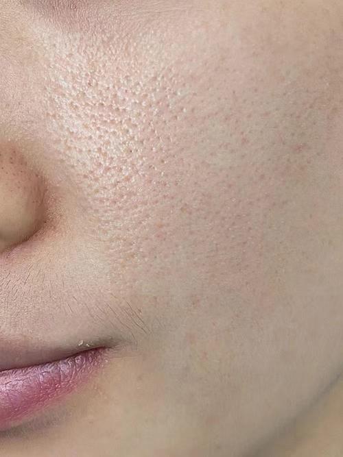 皮肤缺水会导致毛孔变大吗?