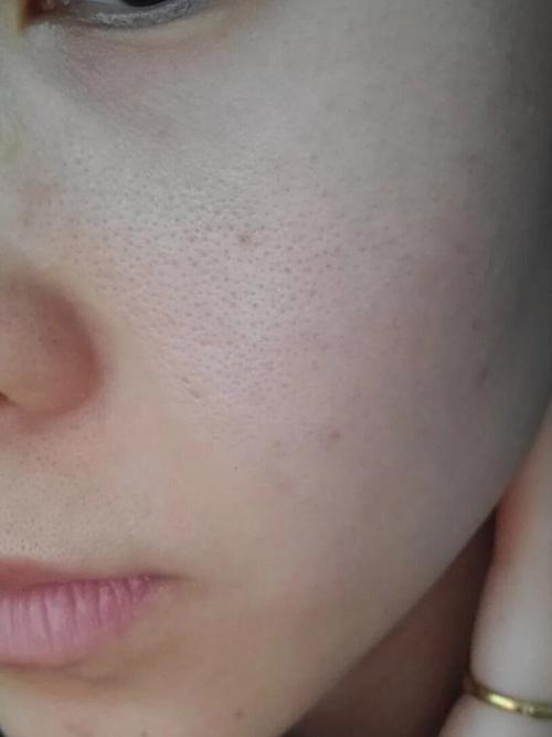 皮肤缺水会导致毛孔变大吗?