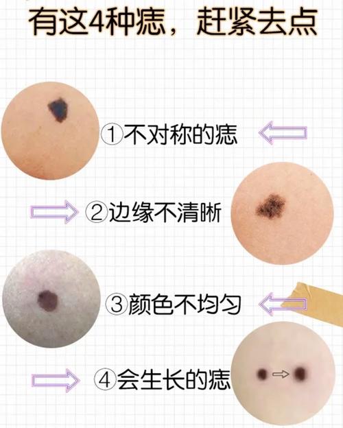 皮肤痣变大是危险信号吗?