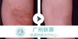 广州市肤康皮肤病医院正规吗?