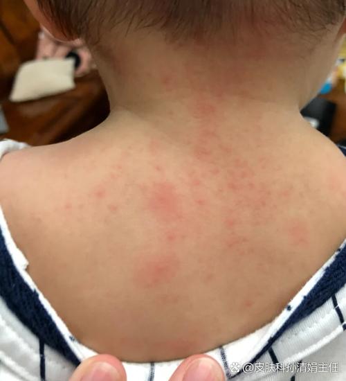 小孩皮肤痒一抓起疙瘩是过敏吗?