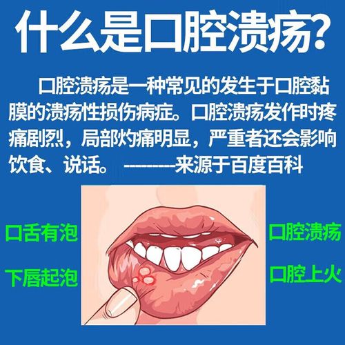 治疗口腔溃疡的药图片