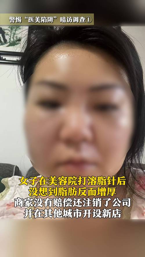 打溶脂针皮肤会松弛吗