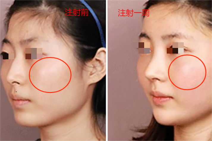 打溶脂针皮肤会松弛吗