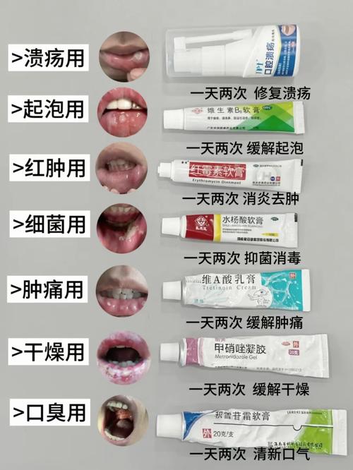 口腔溃疡严重,怎么快速好?