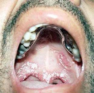 严重口腔溃疡怎么快速治好?