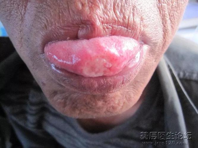 严重口腔溃疡怎么快速治好?