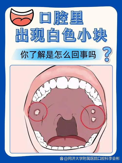 口腔内壁增厚是何原因?