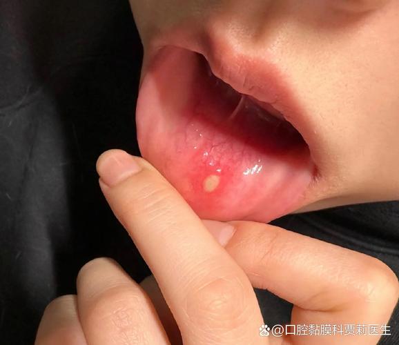 疱疹性口腔溃疡症状有哪些?