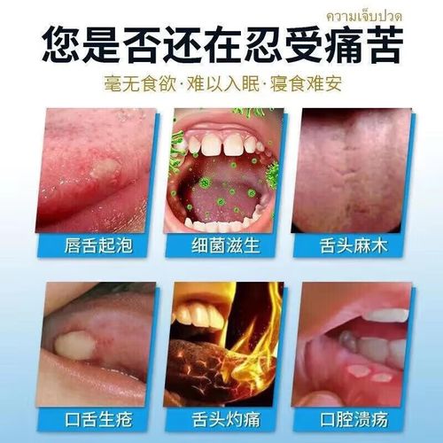 嘴角口腔溃疡怎么治疗