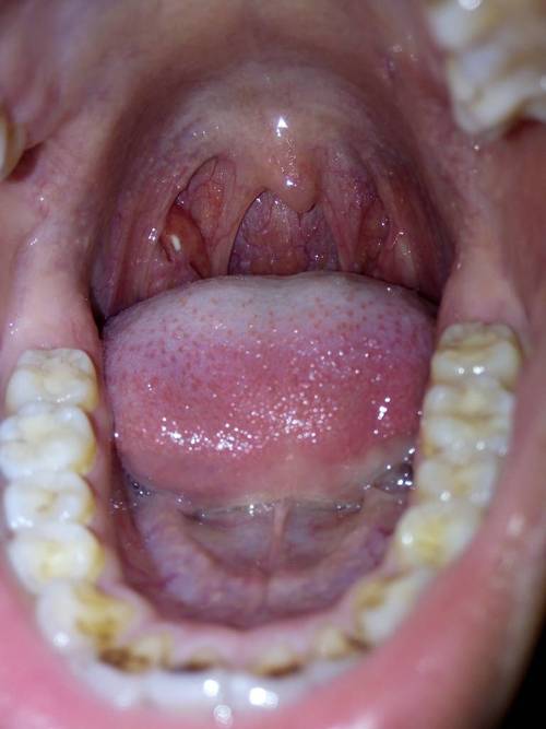 口腔内白点颗粒状是何问题?