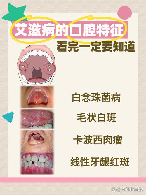 艾滋病的口腔表现图片