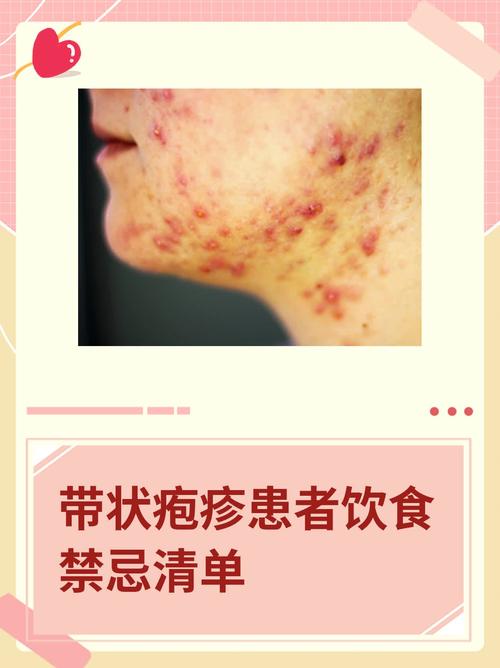 带状疱疹不能吃什么食物