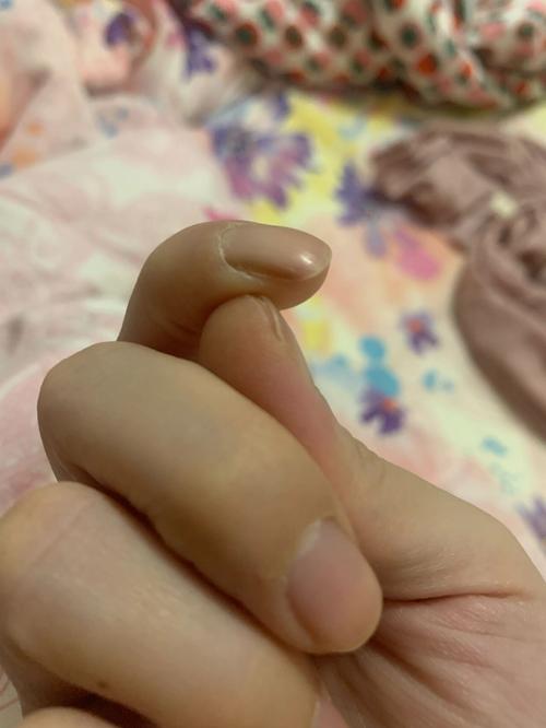 婴儿指甲缘皮肤发黑是何原因?