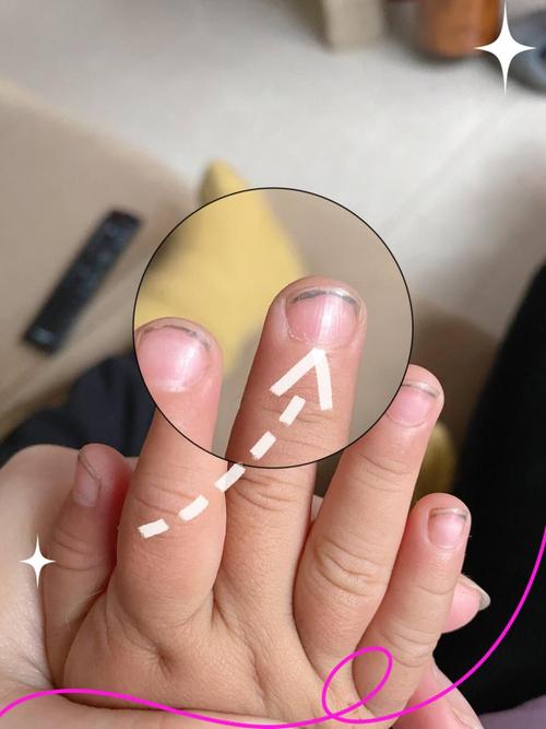 婴儿指甲缘皮肤发黑是何原因?