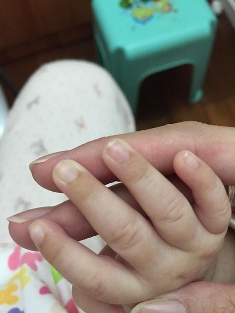 婴儿指甲缘皮肤发黑是何原因?