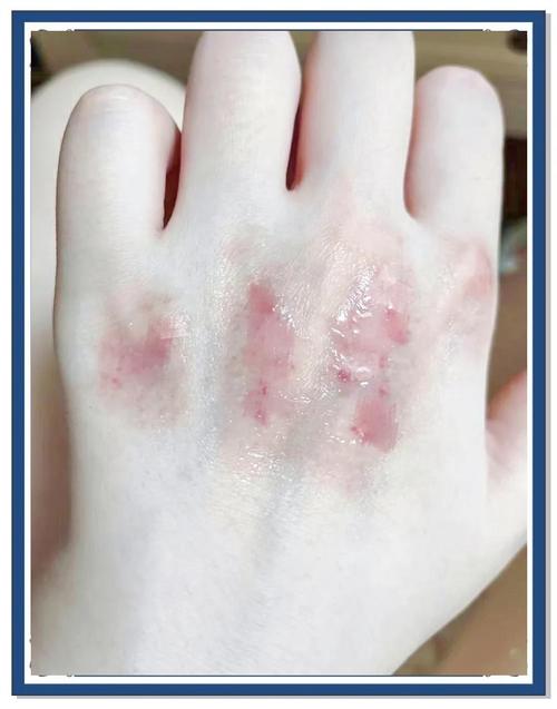 牙膏灼伤皮肤,应急处理该怎么做?