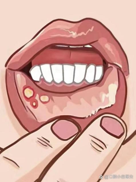 口腔溃疡中间黑点是恶化信号吗?