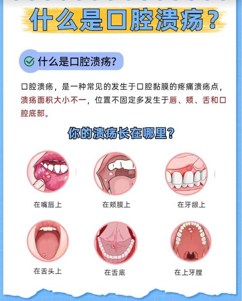 长期口腔溃疡总反复,到底怎么治才好?