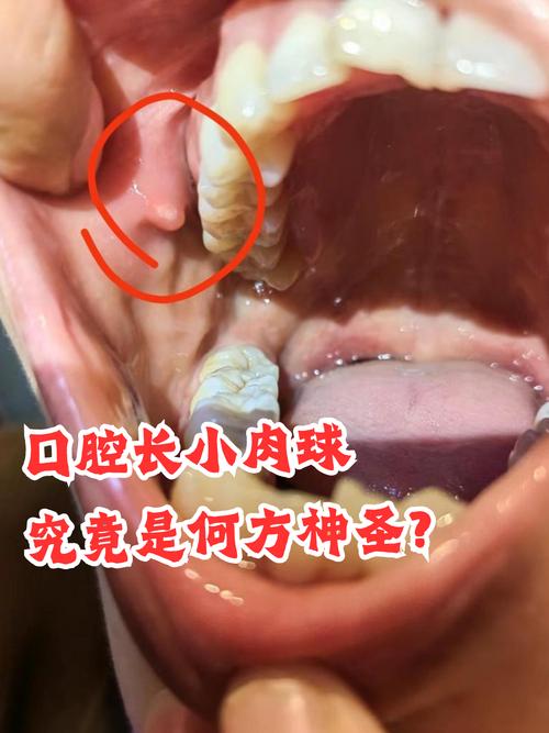 口腔滤泡因何而起?