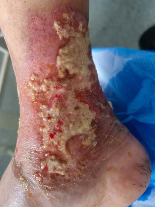 土霉素碾碎治皮肤病安全有效吗?