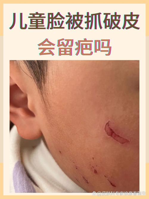 婴儿皮肤破皮了,该怎么处理?