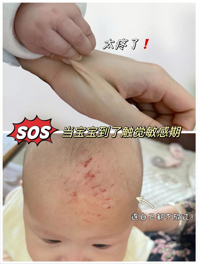 婴儿皮肤破皮了,该怎么处理?